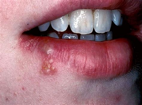 herpes na boca
